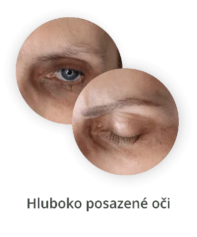 Hluboko posazené oči