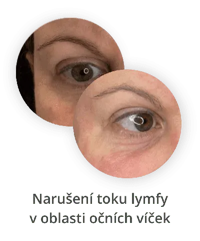 Narušení toku lymfy v oblasti očních víček