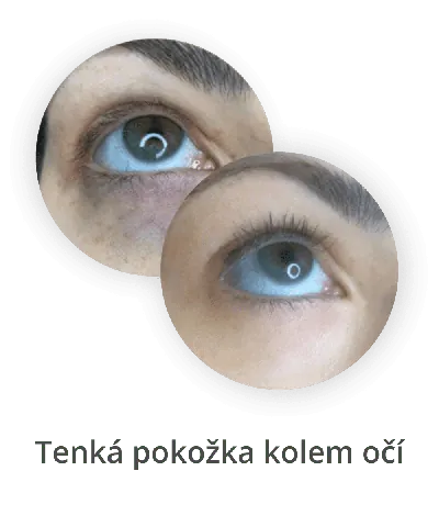 Tenká pokožka kolem očí