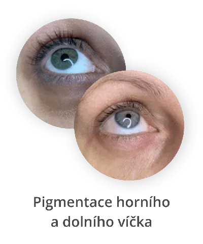 Pigmentace horního a dolního víčka