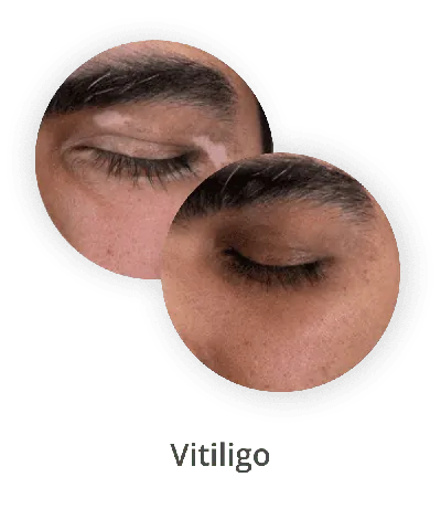 Vitiligo